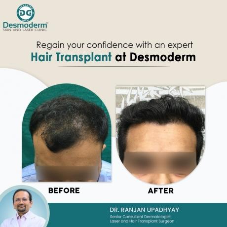 Important Factors to Consider When Choosing a Leading Hair Transplant Clinic